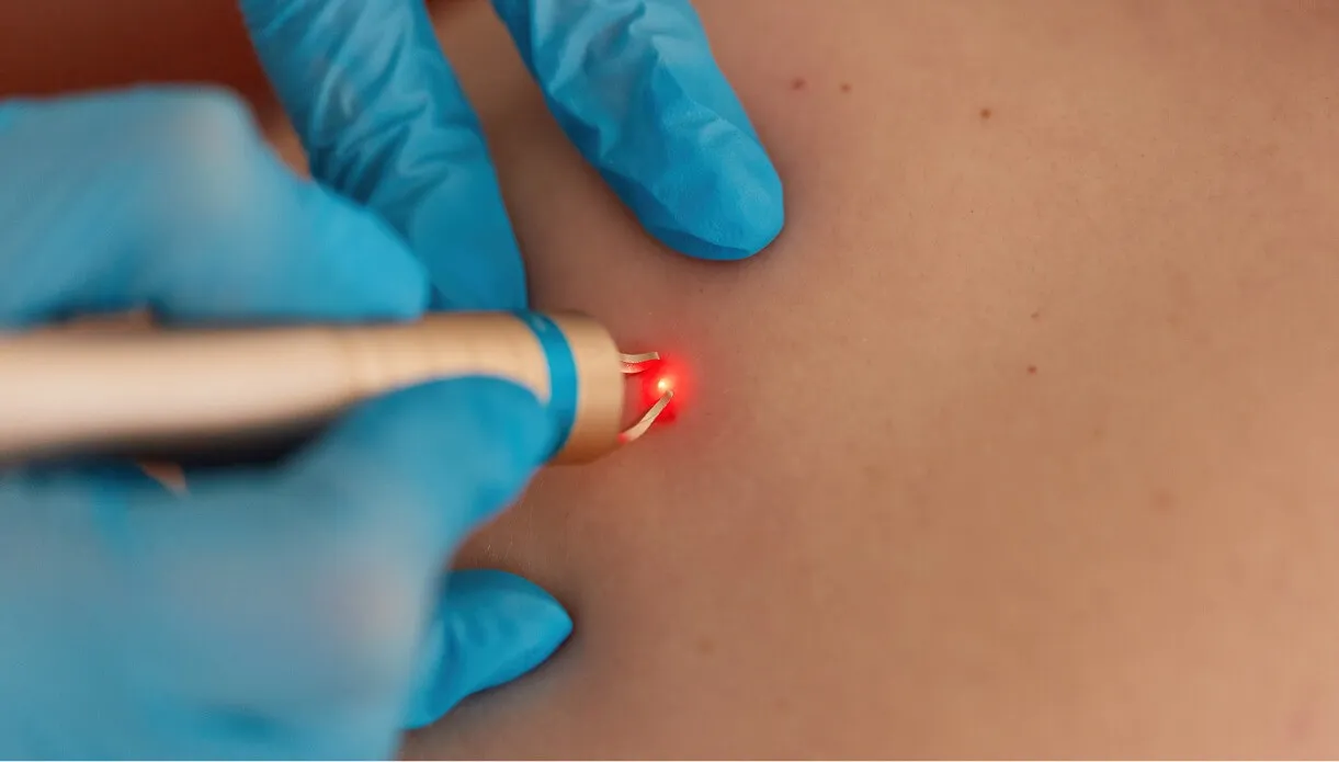 What to Expect During a Laser Test Patch