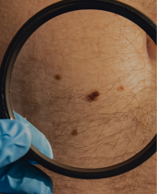 Biopsying a Mole