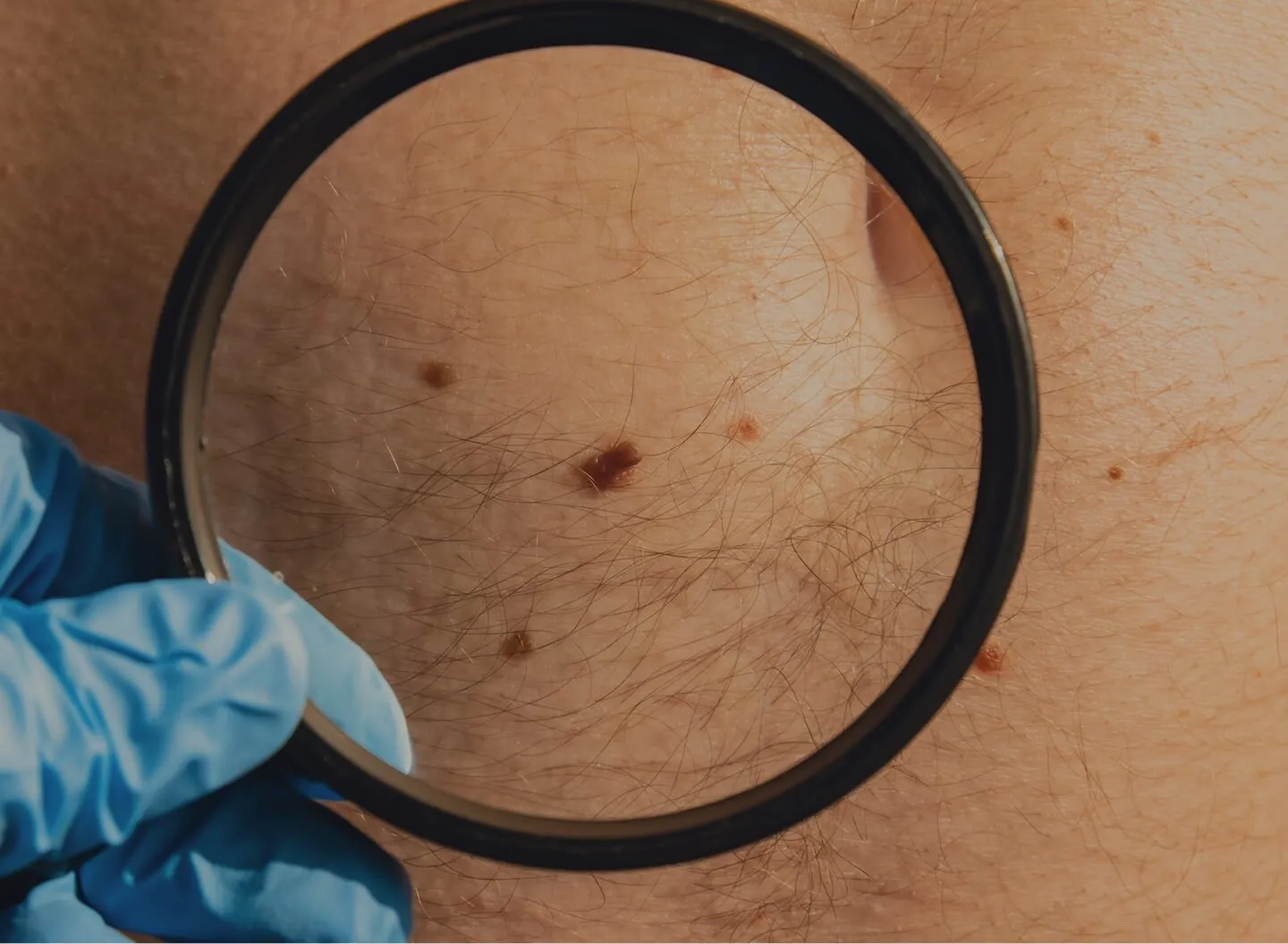 Biopsying a Mole