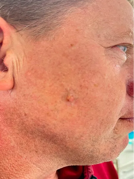 Moles Removal treatment in action
 before result