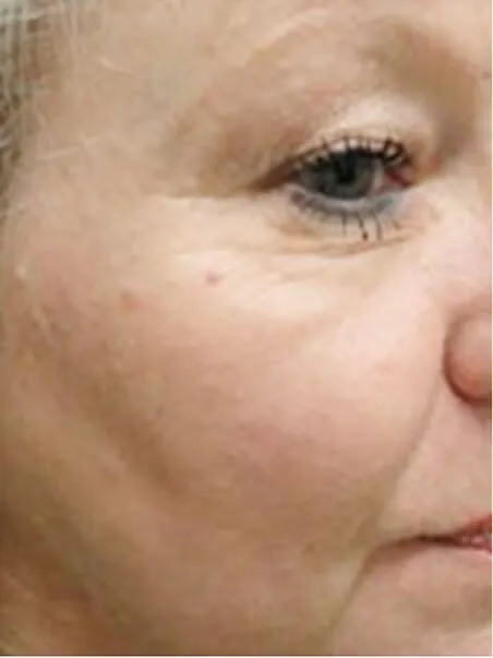 Moles Removal treatment in action
 after result
