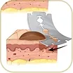 Shave Biopsy