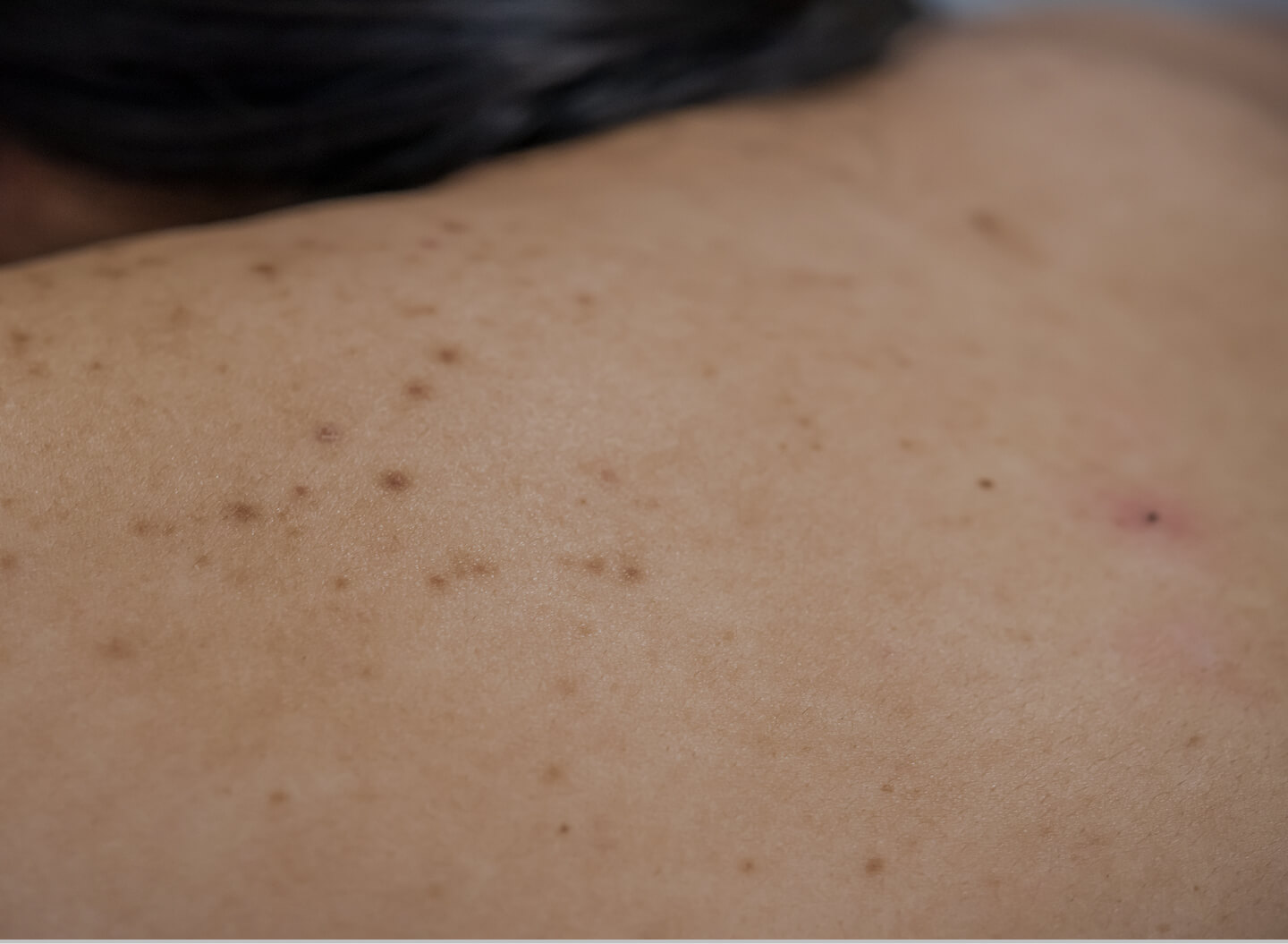 Skin cyst