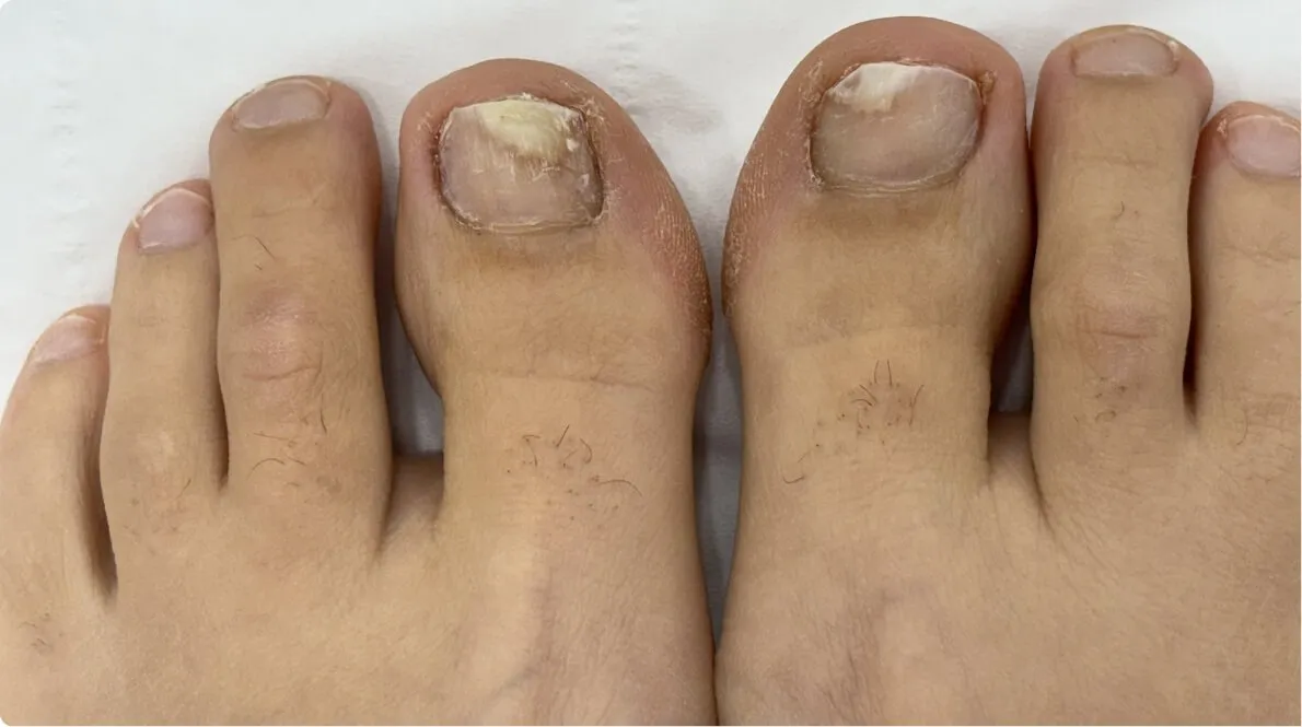 Fungal Nail Infection — Why It’s So Stubborn