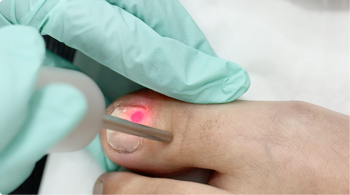 Laser Fungal Nail Treatment with Fotona Nd:YAG: The Expert Way to Restore Healthy Nails content post image