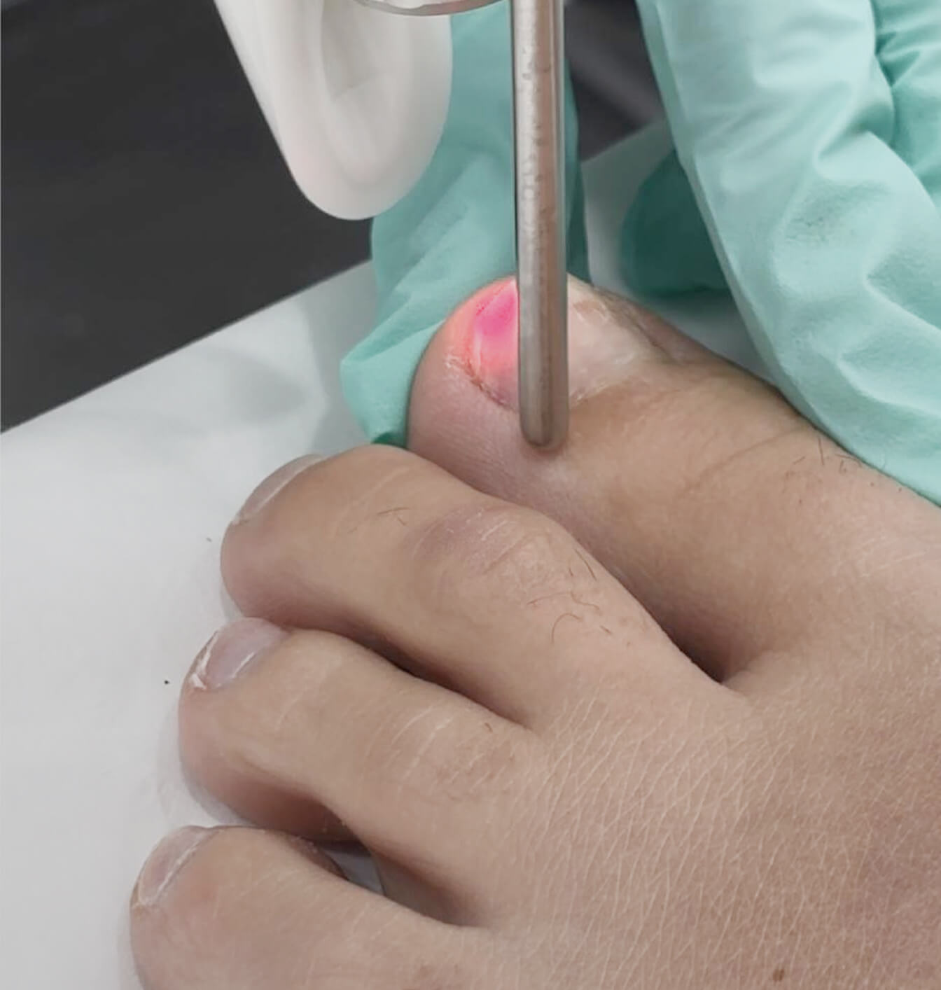 laser fungal nail treatment fotona nd yag
