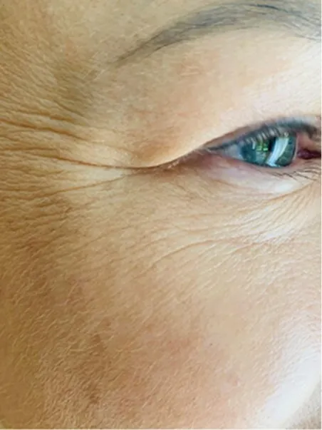 Juvelook &amp; Lenisna Collagen 
Stimulators treatment in action
 after result