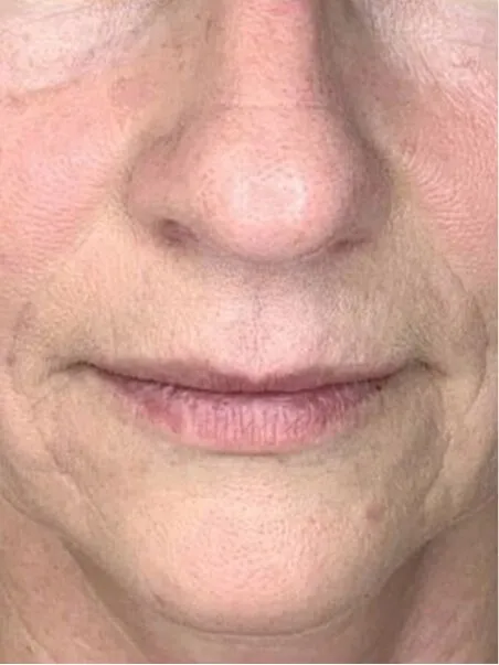 Juvelook &amp; Lenisna Collagen 
Stimulators treatment in action
 after result