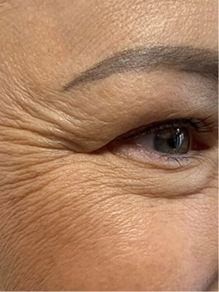 Juvelook &amp; Lenisna Collagen 
Stimulators treatment in action
 before result