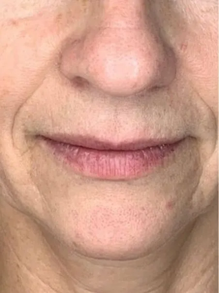 Juvelook &amp; Lenisna Collagen 
Stimulators treatment in action
 before result