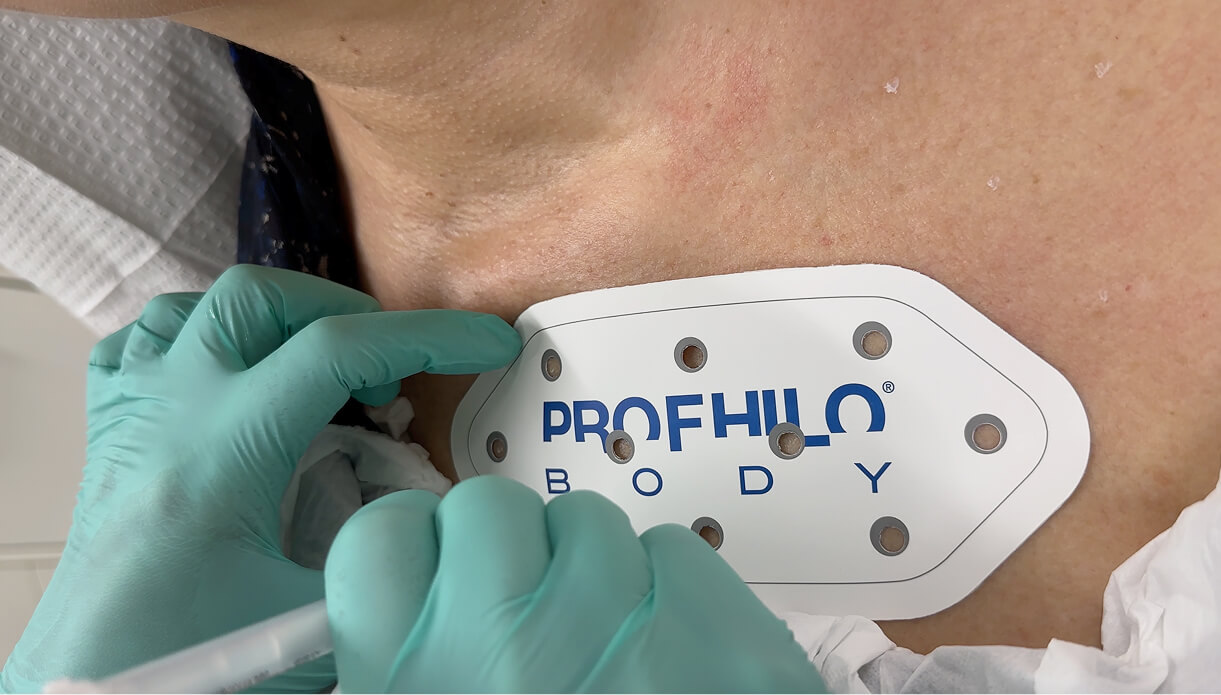 what-is-profhilo what is profhilo