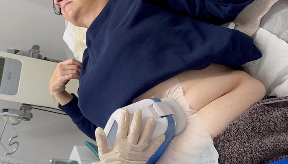 Application of the Cooling Device – The Procedure Begins