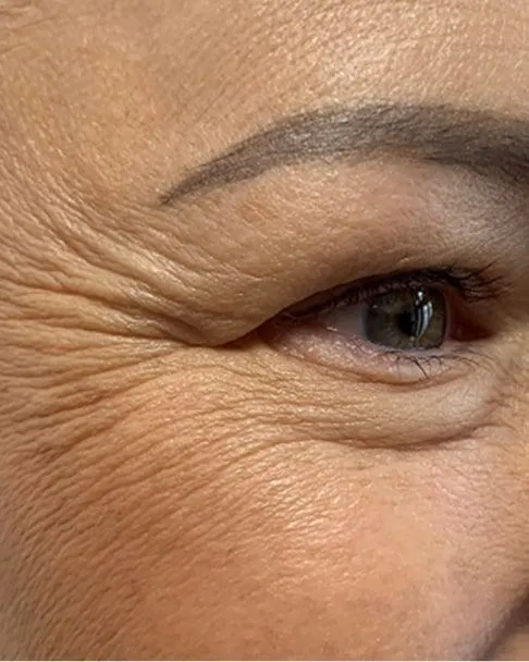 before-juvelook-under-the-eyes
