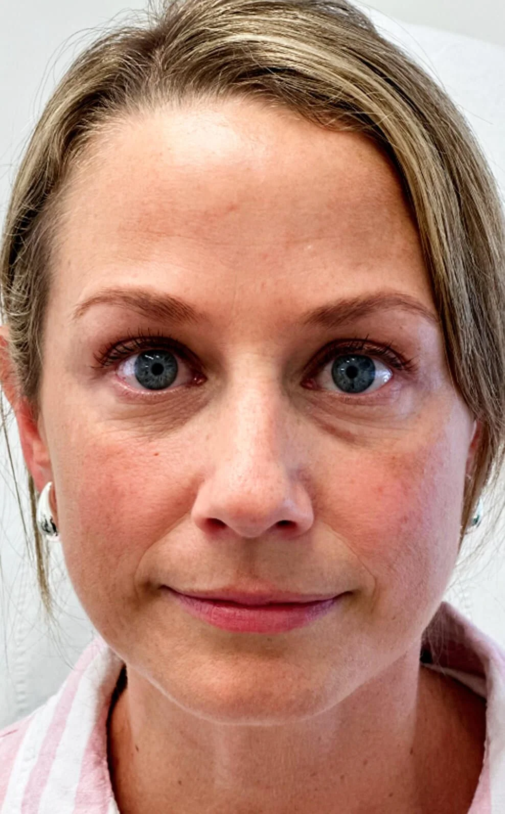 Anti-Wrinkle Treatments in action after results