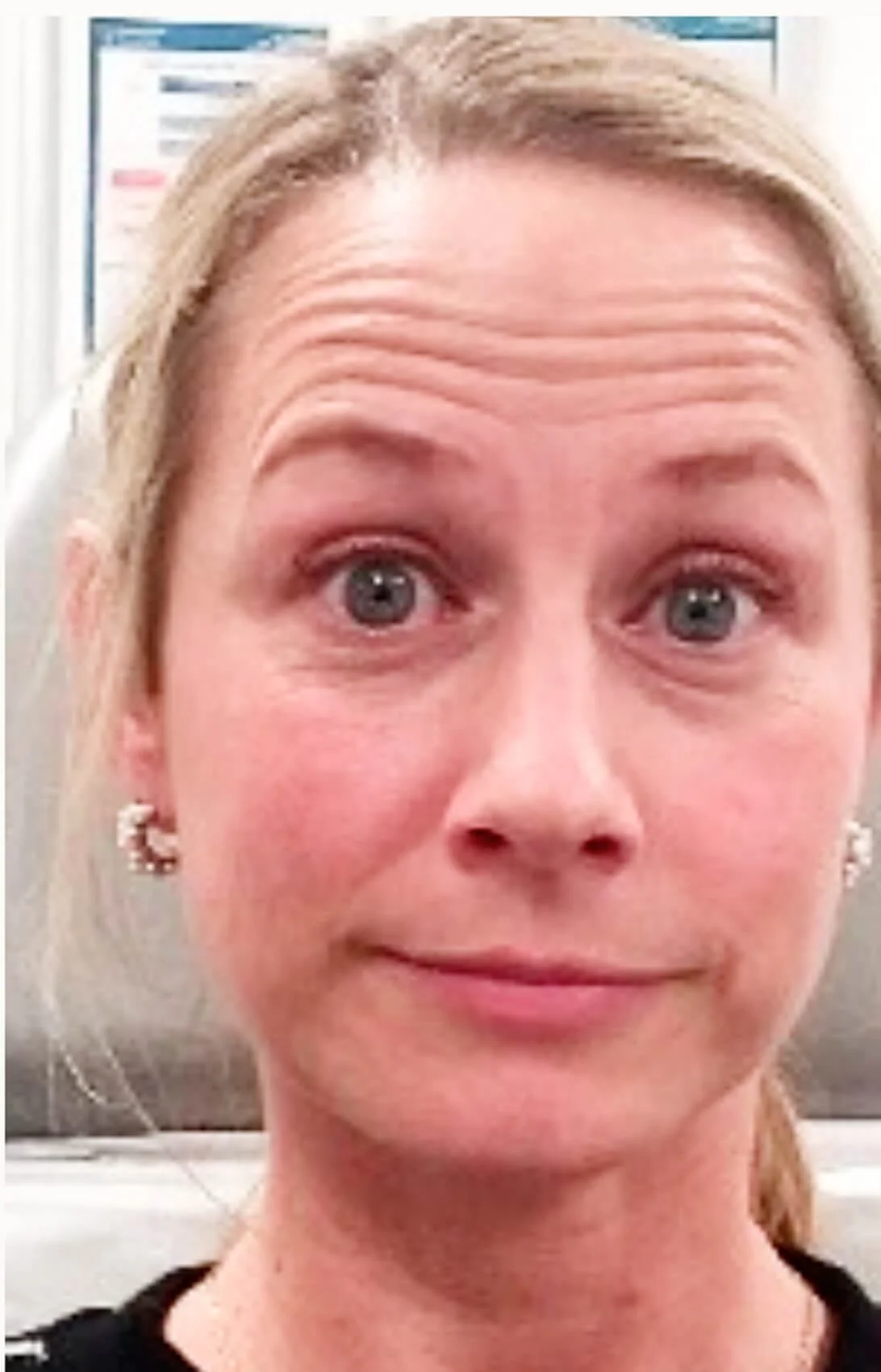 Anti-Wrinkle Treatments in action before results