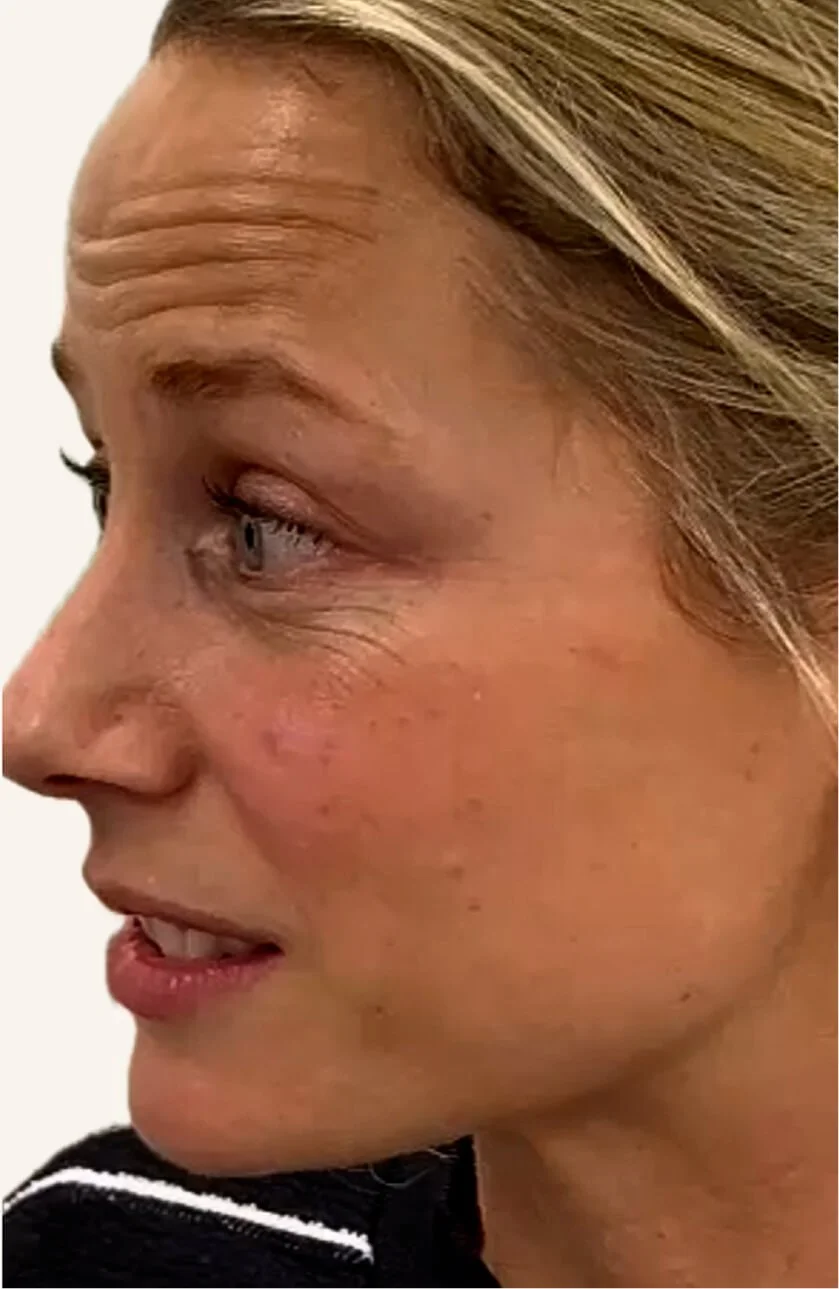 Anti-Wrinkle Treatments in action before results