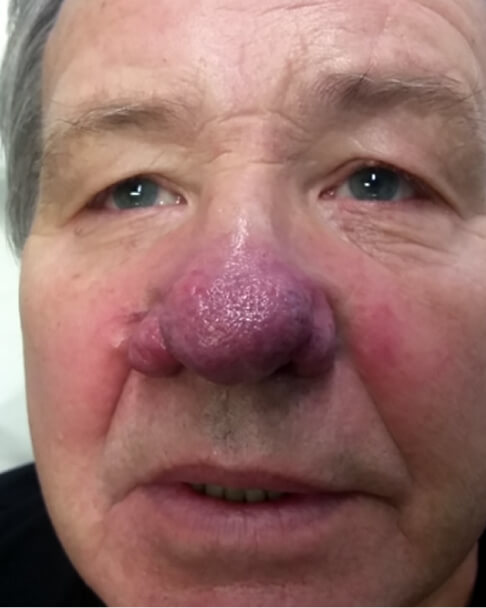 rhinophyma before