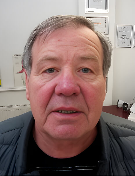 rhinophyma after