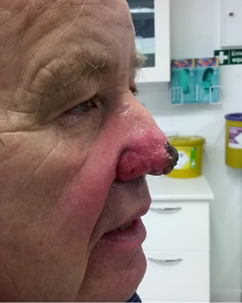 rhinophyma_before_rtwskin