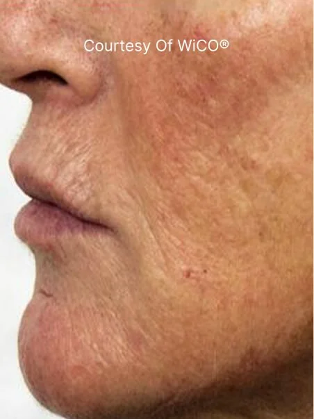 PRX-T33 Before and After Results
 after result