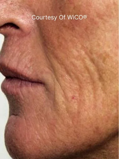 PRX-T33 Before and After Results
 before result