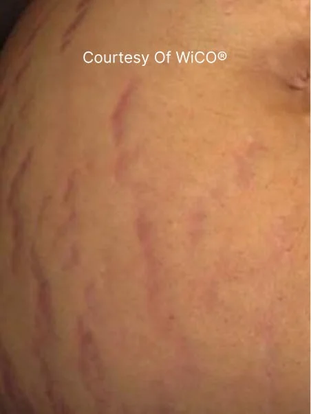 PRX-T33 Before and After Results
 before result