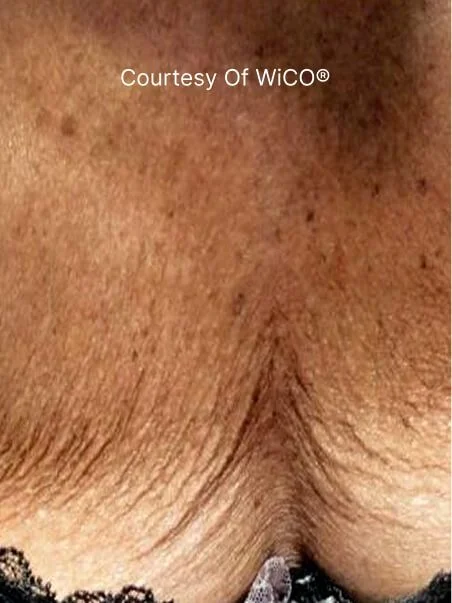 PRX-T33 Before and After Results
 before result