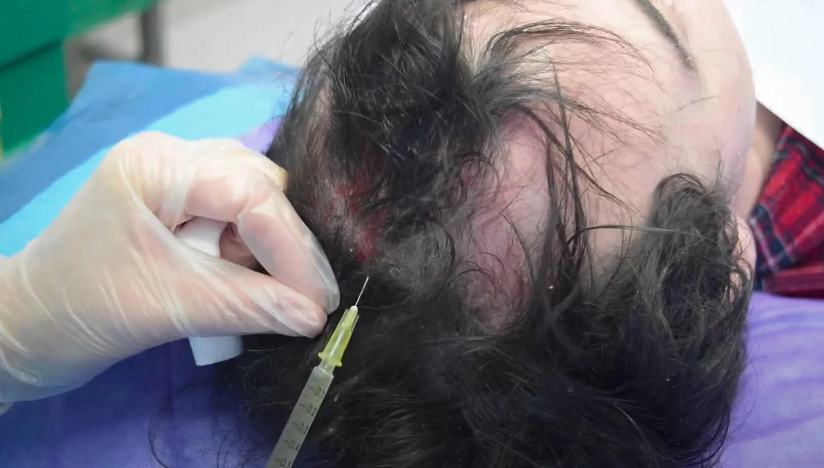 What Is PRP Hair Restoration?
