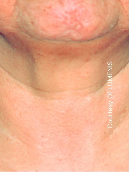 IPL photo rejuvenation in action after results