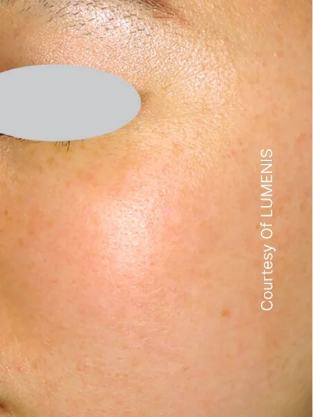 IPL photo rejuvenation in action after results