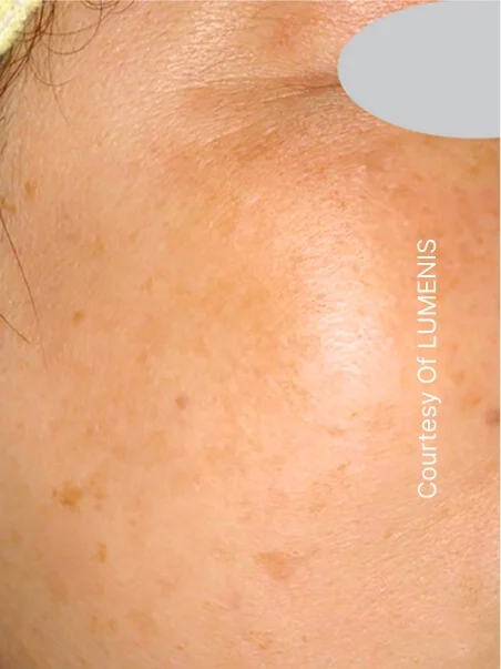 IPL photo rejuvenation in action after results
