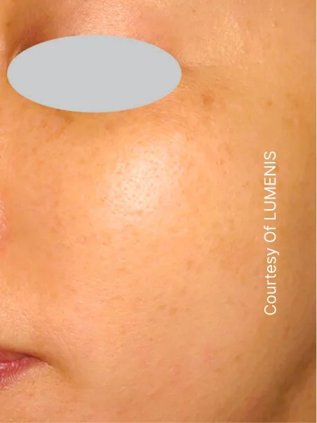 IPL photo rejuvenation in action after results
