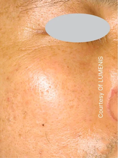 IPL photo rejuvenation in action after results