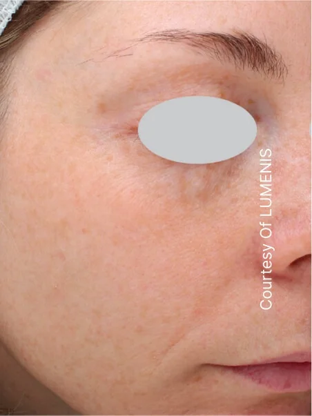 IPL photo rejuvenation in action after results