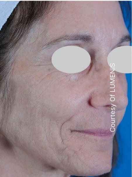 IPL photo rejuvenation in action after results