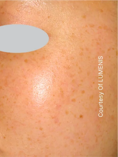IPL photo rejuvenation in action before results