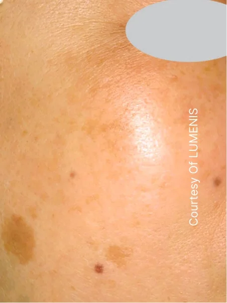 IPL photo rejuvenation in action before results