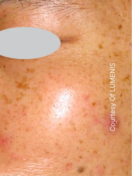 IPL photo rejuvenation in action before results