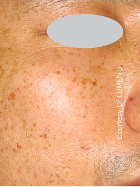 IPL photo rejuvenation in action before results