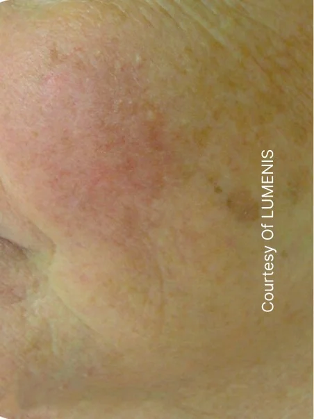 IPL photo rejuvenation in action before results