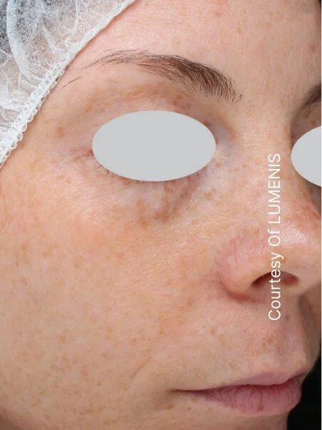 IPL photo rejuvenation in action before results