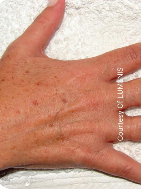 IPL photo rejuvenation in action before results