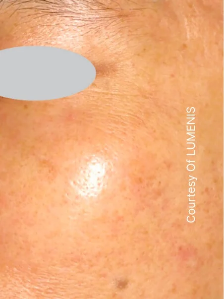 IPL photo rejuvenation in action after results