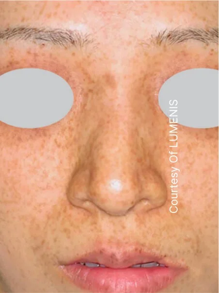 Pigmentation treatment  in action after results