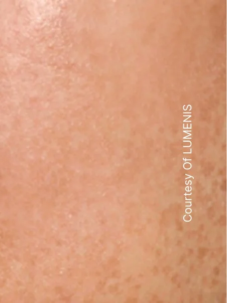 Pigmentation treatment  in action after results