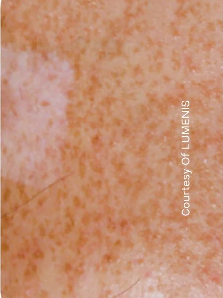 Pigmentation treatment  in action before results