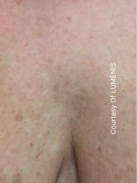 Pigmentation treatment  in action before results