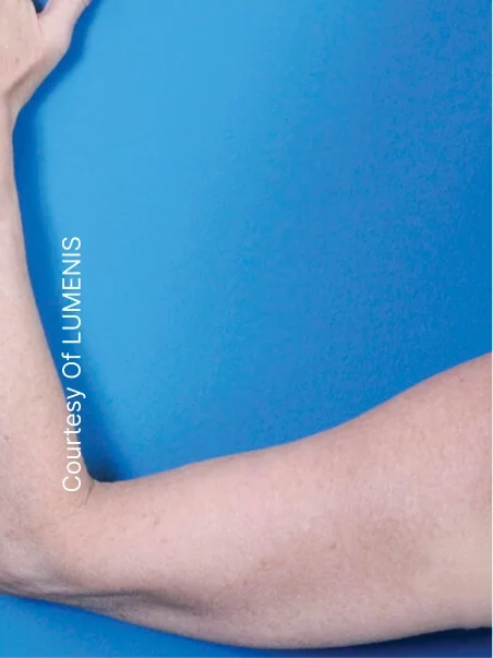 Pigmentation treatment  in action after results