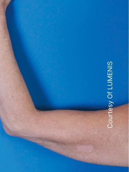 Pigmentation treatment  in action before results