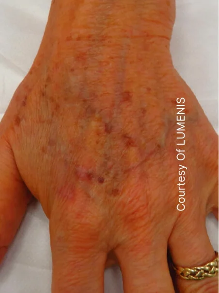 Pigmentation treatment  in action before results